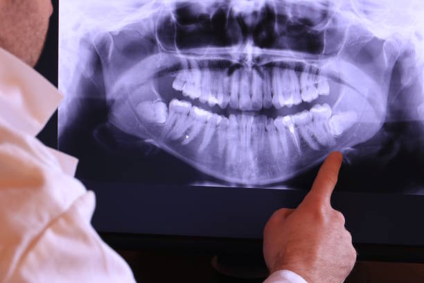 Best Emergency Wisdom Teeth Removal in Gate City, VA
