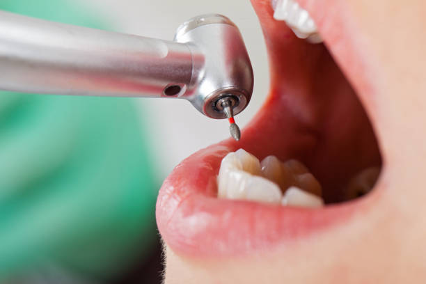 Best Emergency Tooth Extraction in Gate City, VA
